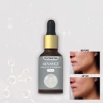 Advance Anti-acne & Whitening Serum